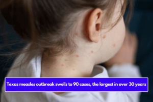 Texas measles outbreak swells to 90 cases, the largest in over 30 years